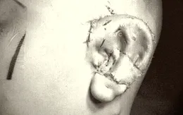 Phẫu thuật thành công kỹ thuật tạo hình tai nhỏ microtia tiên tiến nhất thế giới