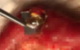 Lại một ca thủng ruột vì uống thuốc còn nguyên vỏ