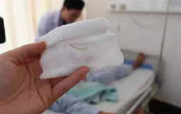 Sốt cao, đau quặn bụng vì xương cá