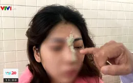 Cô gái trẻ bị mù mắt sau tiêm filler nâng mũi tại spa