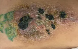 Nhiều nguy cơ tiềm ẩn khi xăm mình