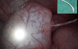 Buộc phải cắt bỏ túi thừa Meckel do xương cá đâm thủng