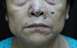 Các yếu tố nguy cơ gây ung thư da