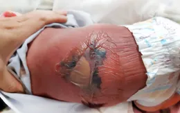 Trẻ sơ sinh bỏng nặng, nhiễm trùng máu do sưởi ấm bằng than