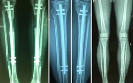 Kéo dài chân an toàn - Những điều cần biết