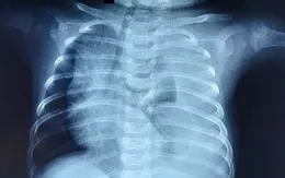 Cứu bé 3 tháng tuổi phổi trắng xóa vì rò dịch dưỡng chấp