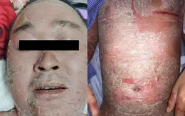 Bùng phát vảy nến toàn thân vì "tin" dùng thuốc nam