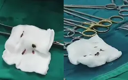 Đau bụng nhiều ngày, vào viện phát hiện... hàng nghìn con sán lá gan trong đường mật