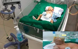 Cứu trẻ sơ sinh có toàn bộ nội tạng... nằm ngoài ổ bụng