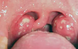 Có cần thiết cắt amidan ở mọi người hay không?