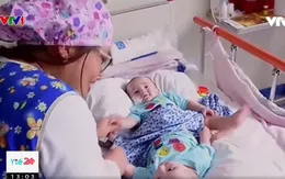 Phẫu thuật thành công cho cặp song sinh dính liền hy hữu