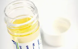 Xét nghiệm tại nhà phát hiện sớm ung thư tuyến tiền liệt