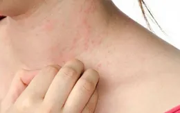 Phát triển cách thức chữa trị bệnh phát ban đỏ