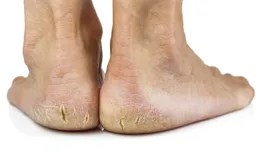 Chăm sóc gót chân nứt nẻ vào mùa đông