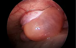 Thoát vị bẹn ở trẻ em - bệnh lý thường gặp nhưng nguy hiểm