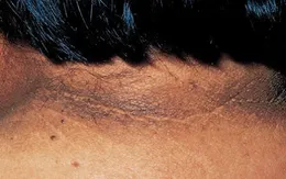 12 dấu hiệu ở da cảnh báo bệnh đái tháo đường