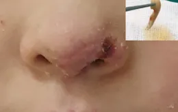 Hy hữu: Tìm cánh mũi trong thùng rác mang tới viện để ghép