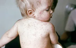Hơn 140.000 người thiệt mạng vì bệnh sởi do không được tiêm vaccine