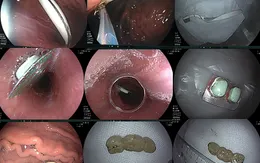 Liên tục lấy bàn chải đánh răng, vỉ thuốc, cầu răng giả... trong dạ dày bệnh nhân
