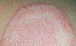 Bệnh hắc lào lây qua con đường nào?