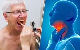 Đau họng kéo dài có thể là dấu hiệu ung thư