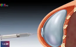Gần 500 phụ nữ Mỹ bị ung thư do nâng ngực