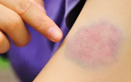 Cảnh báo ung thư qua vết bầm tím trên cơ thể