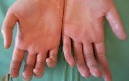 Thoát khỏi nỗi lo tăng tiết mồ hôi tay