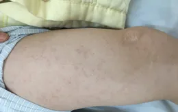 Hà Nội: Một trường hợp biến chứng viêm não - màng não do sởi