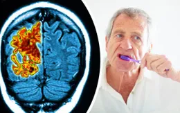 Bệnh răng lợi và sự tiến triển của bệnh Alzheimer