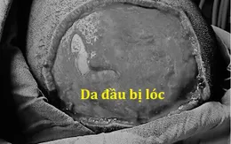 Bé gái bị rách cả mảng da đầu do bị cuốn vào máy xay tiêu