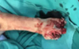 Thêm một trường hợp trẻ nát tay do vừa sạc pin vừa dùng điện thoại