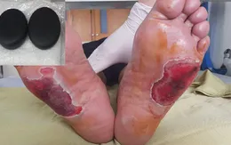 "Cặp đá kỳ diệu" gây bỏng nặng cho người bệnh đái tháo đường