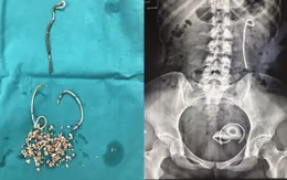 Cô gái trẻ bị bỏ quên... stent trong niệu quản suốt 5 năm