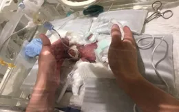 Em bé sơ sinh nhỏ nhất thế giới xuất viện khỏe mạnh