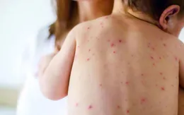 Báo động dịch sởi hoành hành trở lại tại Mỹ