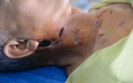 Tưởng quai bị đắp lá chữa, bệnh nhân đái tháo đường nhập viện nguy kịch do biến chứng