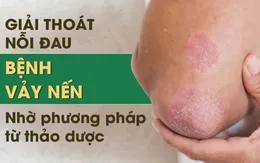 Bệnh vảy nến và cách điều trị hiệu quả, ngăn tái phát