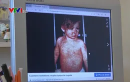 Dịch sởi bùng phát trên toàn cầu