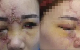 Tiêm chất làm đầy: lưu ý các vùng nguy hiểm