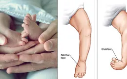 Khoảng 200 trẻ nhỏ tại Fiji cần được điều trị chân vòng kiềng mỗi năm