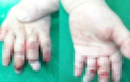 Bé 16 tháng tuổi dập nát tay do cuốn vào máy xay thịt