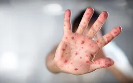 Nguy cơ bùng phát dịch sởi nghiêm trọng nhất trong nhiều thập kỷ tại Litva