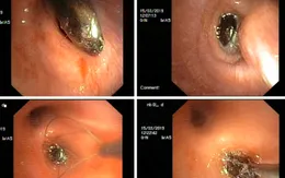 Ho suốt 1 tháng trời vì hạt hồng xiêm "trốn" trong phế quản