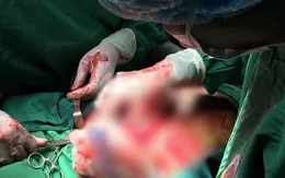 Bác sĩ vừa lấy tay bịt máu phun vừa khâu vết thương tim cho bệnh nhân