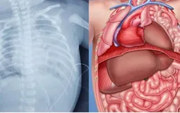 Phẫu thuật thoát vị cơ hoành bẩm sinh cho trẻ 2 ngày tuổi