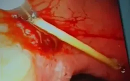 Cận cảnh ca rút cây tăm dài 8cm khỏi dạ dày bệnh nhân