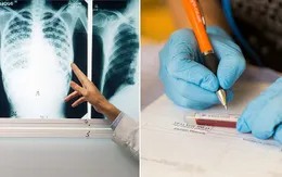 Bệnh lao có thể được "thanh toán" vào năm 2045