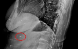 Rùng mình sán lá gan ký sinh khắp cơ thể một phụ nữ