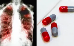 Lao là bệnh truyền nhiễm gây tử vong hàng đầu thế giới